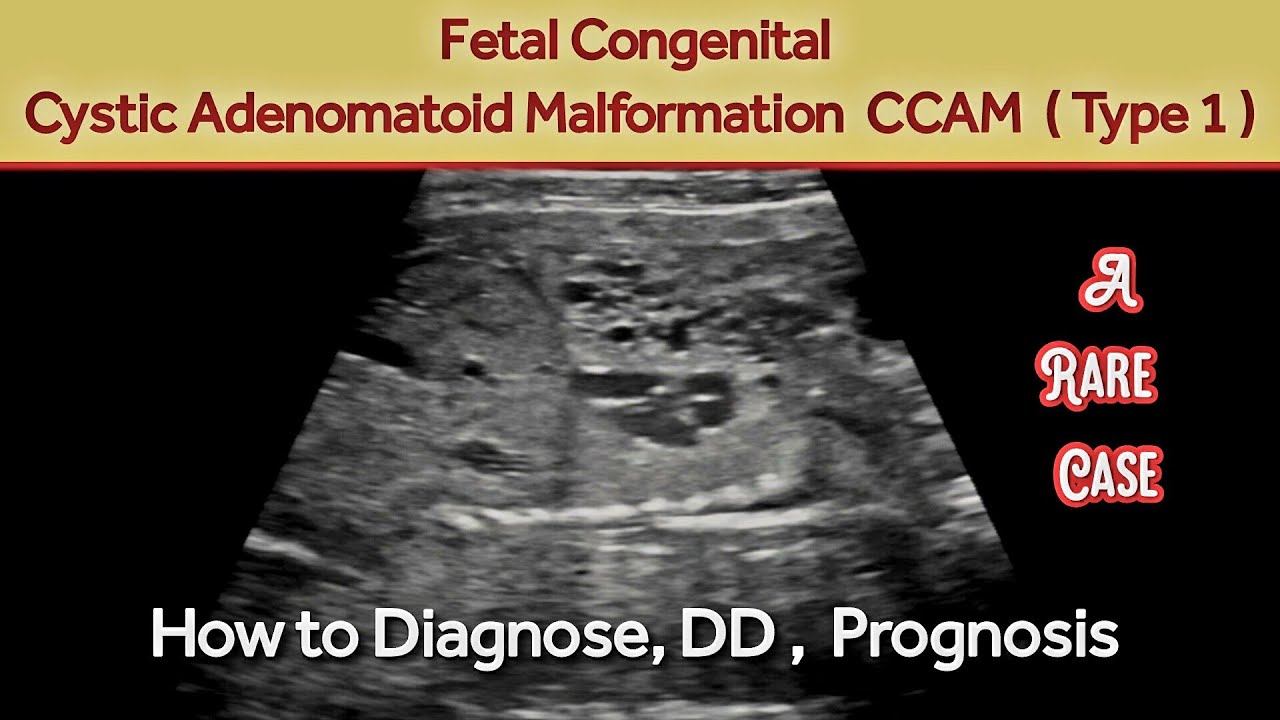 Fetal Cystic Adenomatoid Malformation CCAM CPAM OBS Ultrasound fetal-cystic-adenomatoid-malformation-ccam-cpam-obs-ultrasound