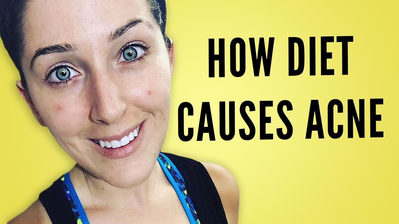 THE TRUTH ABOUT DIET AND ACNE YouTube