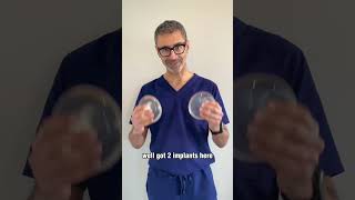 Uniboob…symmastia #beverlyhillsplasticsurgery #symmastia #breastimplants #boobjob #plasticsurgeon