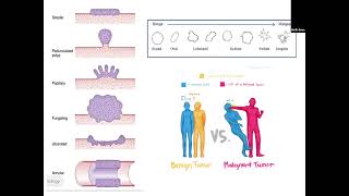 Gen Path 8.6: Is it Benign or Malignant? Keys to gross assessment.