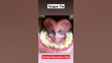 Tongue-Tie / Ankyloglossia