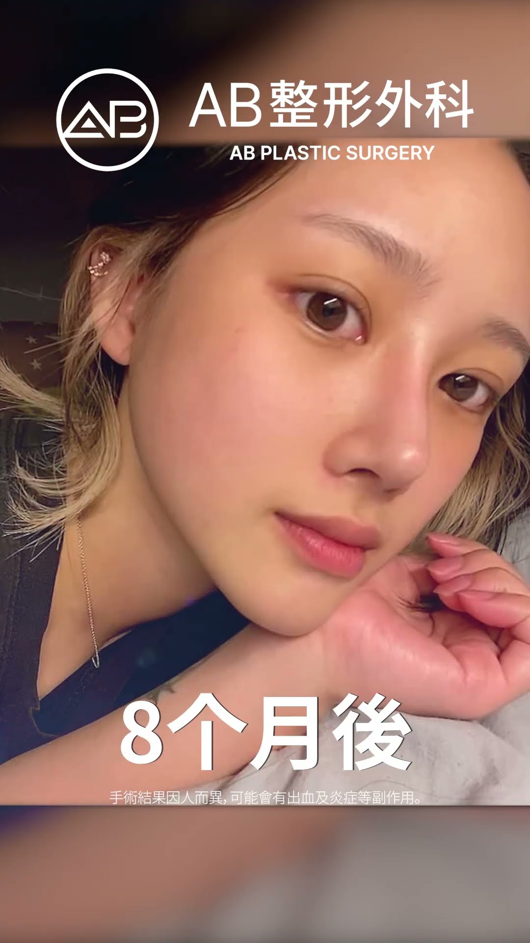 韓國頂級整形術！眼睛、鼻子、臉型變化全記錄 | AB整形外科 #短片 #shorts
