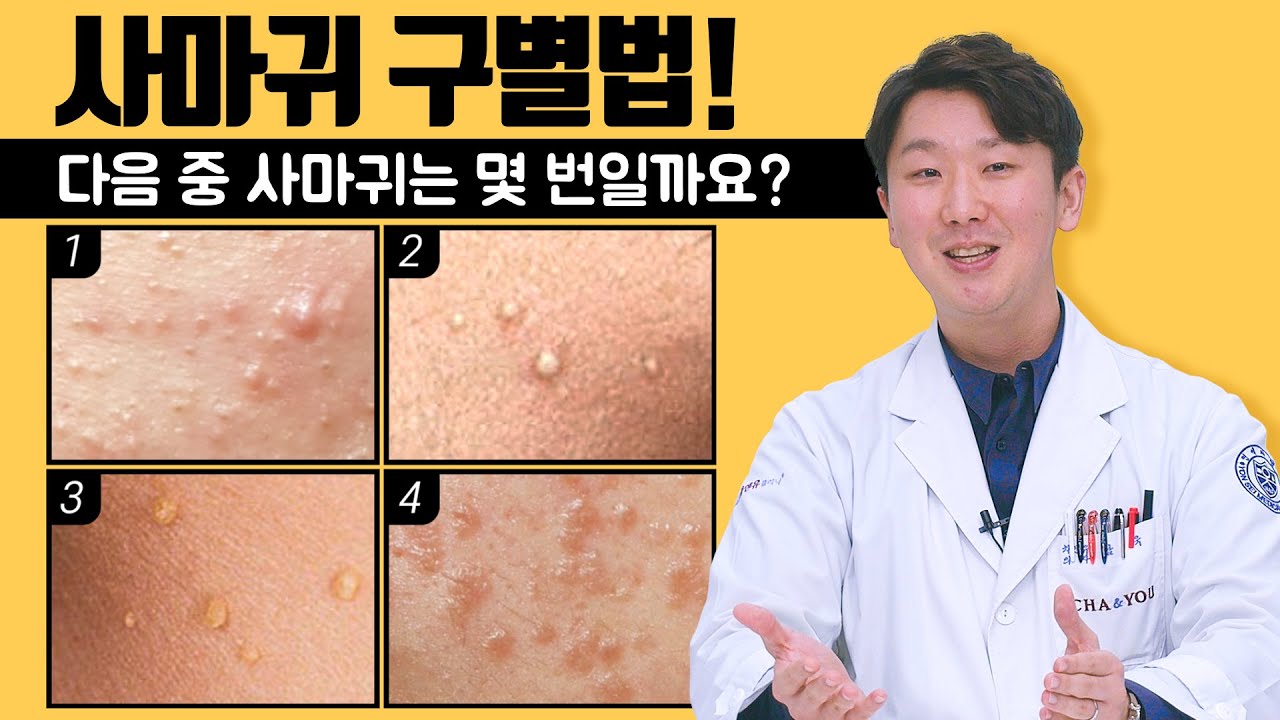 사마귀 방치하면 번진다던데😭 쥐젖, 좁쌀여드름이랑 어떻게 구분하죠? - Youtube