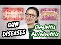 GUM DISEASE: Gingivitis and Periodontitis 🦷 Namamagang gilagid, masama ba? | Dr. Bianca Beley