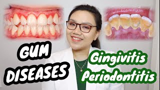 GUM DISEASE: Gingivitis and Periodontitis 🦷 Namamagang gilagid, masama ba? | Dr. Bianca Beley