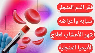 أشهر الأعشاب لعلاج فقر الدم المنجلي/ أسباب وأعراض الأنيميا المنجلية