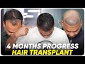 Hair transplant in india  best results  cost of hair transplant in india