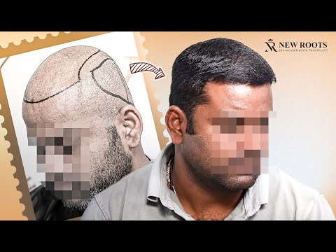 This Hair Growth Speed 'SHOCKED' Everyone 😨 | Hair Transplant in Bangalore | New Roots | Bengaluru