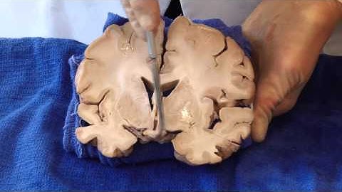 The Visual Pathway: Neuroanatomy Video Lab - Brain Dissections