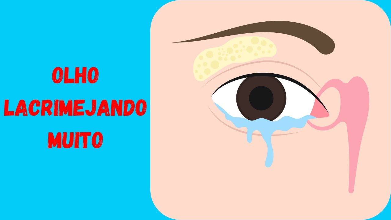 Olho Lacrimejando De Um Lado Só - Epífora - Olho Com Muita Lágrima E ...
