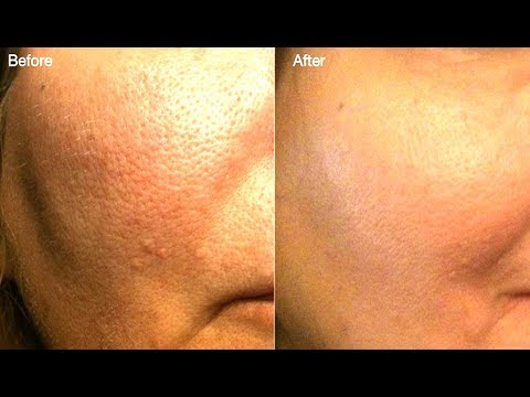 Repair Damaged Skin -Close Large OPEN PORES OVERNIGHT - Remove Dark spot, Hyper pigmentation How