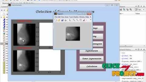 Final Year Projects | Detection of Suspicious Lesions by Adaptive Thresholding Based on Multireso