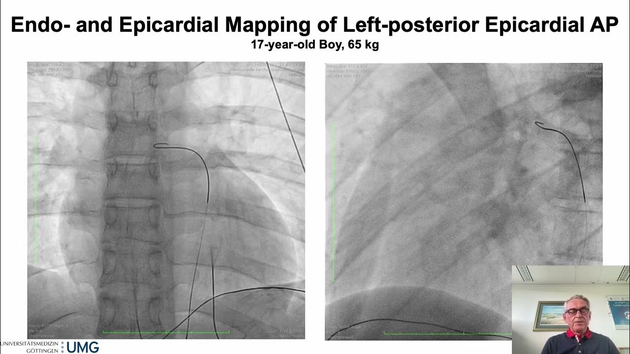 How to Approach Epicardial Accessory Pathways YouTube