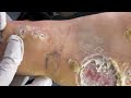 Net jigger asmr corne feet warts