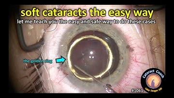 CataractCoach 1061: soft cataracts the easy and safe way