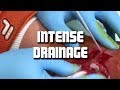 Large Abscess or Infection?   Inside the Emergency Room with Dr  ER