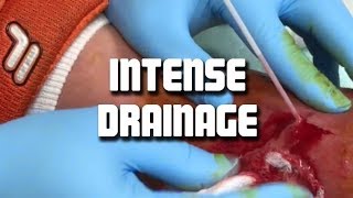 Large Abscess or Infection? Inside the Emergency Room with Dr ER