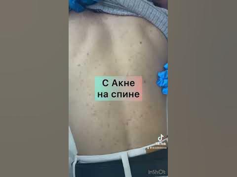 как лечить акне на спине - YouTube