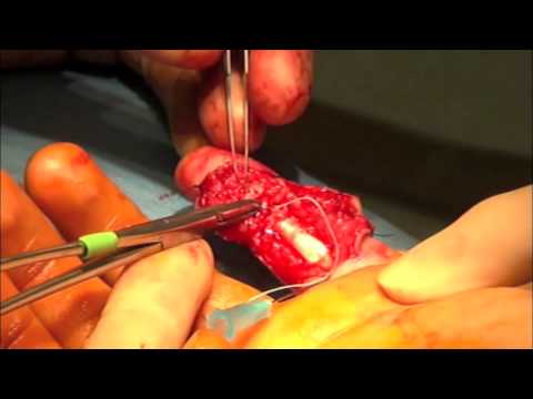 Flexor tendon repair by Utah Plastic Surgeon Dr. York Yates. - YouTube