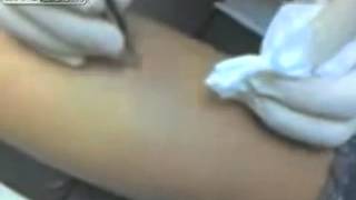 Woman has cyst drained at doctor office