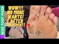 WARTS ON FEET TREATMENT AND FINAL RESULTS [Wart Scraping] BY MISS FOOT FIXER