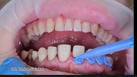 how to take a perfect dental impression (two step technique)