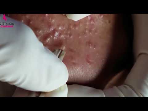 Cystic Acne Treatment Dermatologist. How To Remove Cyst Acne Treatment At Home