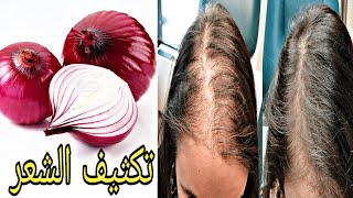 علاج تساقط الشعر والصلع // Hair loss and baldness treatment