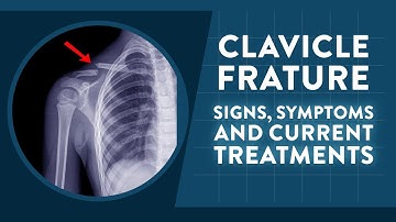 Clavicle fracture: Signs, symptoms and current treatments
