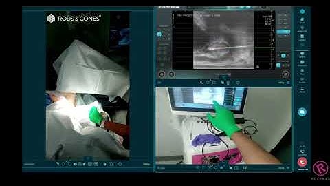 EchoLaser® TPLA™ - Live Surgery Days with Dr. Parekattil