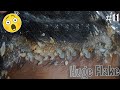 HUGE FLAKES!!! Scratching Psoriasis Scalp!! Huge Dandruff Removal