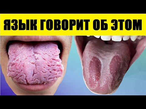 Вот 20 Вещей, Которые Ваш Язык Пытается Рассказать о Вашем Здоровье. Не Игнорируйте Это...