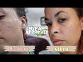 How I smooth my textured skin after Cancer | Fungal Acne skincare routine | Hyram approved
