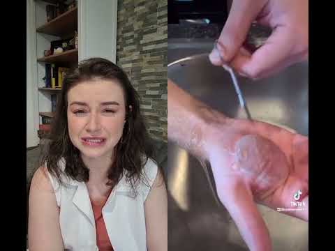 Vídeo: Como fazer uma bolha enorme curar (com fotos)