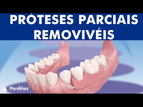 Assista: Próteses Parciais Removivéis. O que é uma prótese parcial removível e como funciona?