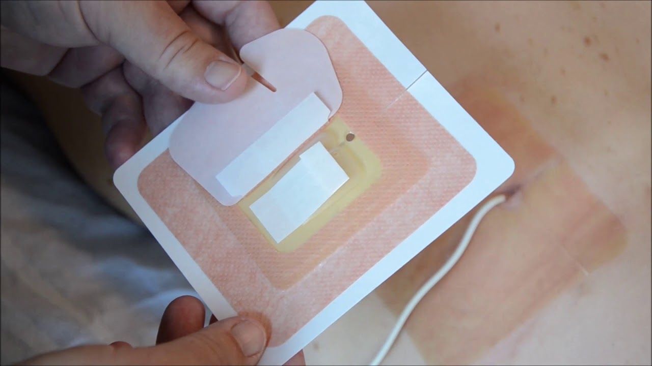 Verzorging van de nefrostomie katheter