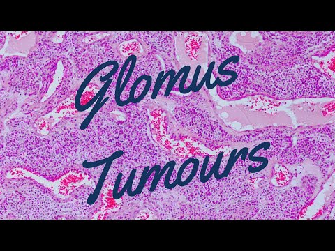Glomustumoren - Pathologie Mini-Tutorial