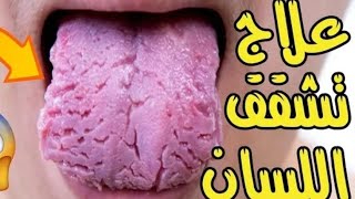 تشققات اللسان اسبابه ، نصائح و وصفة لعلاجه