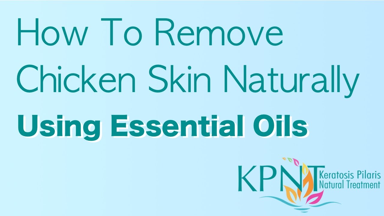 How To Get Rid Of Nasal Drip Naturally How To Get Rid Of Nasal Drip Naturally