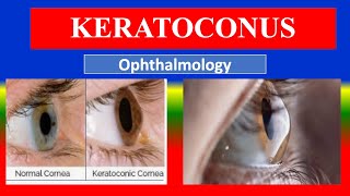 Keratoconus Explained - Causes, Symptoms, Diagnosis Treatment For Nursing, Medical, Paramedical