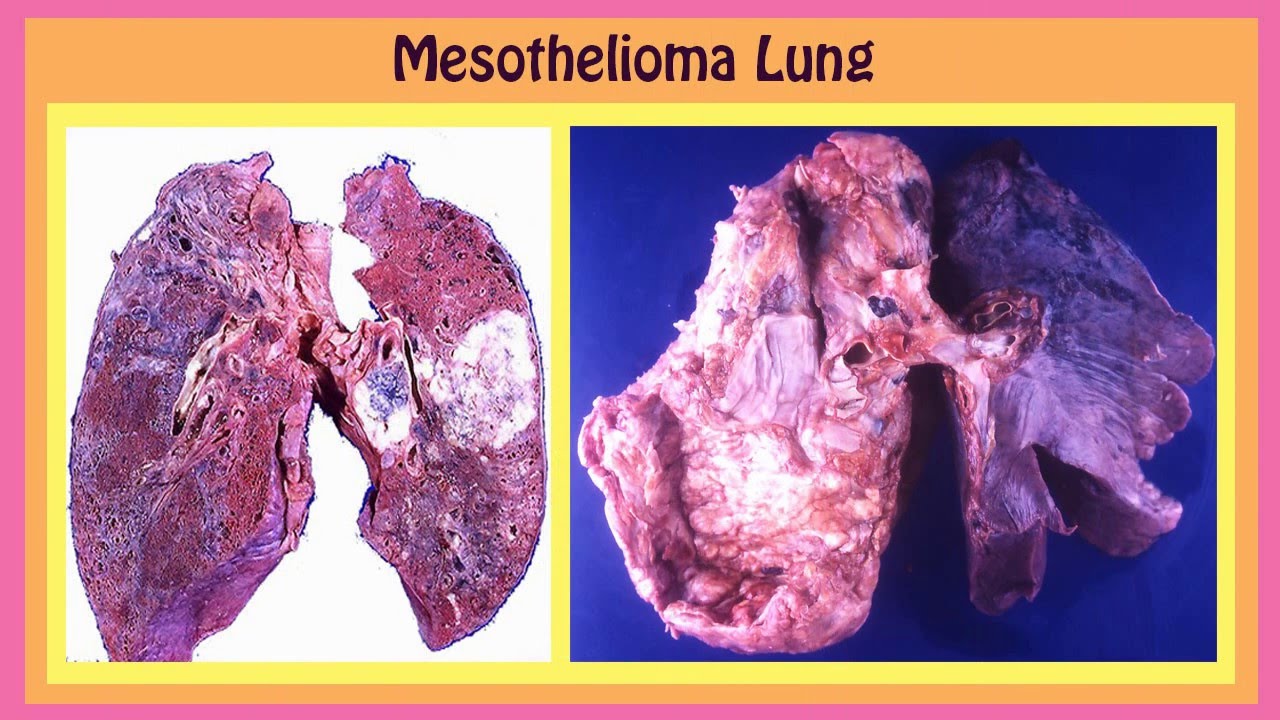 survival after mesothelioma