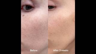 Series 2 CurrentBody LED mask results after just 3 weeks. 10% off with code SARAHSCB