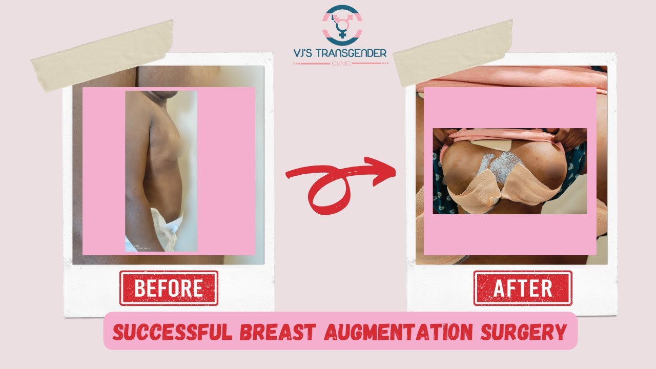 Successful Breast Augmentation at VJsTransgender Clinic #VJsTransformation  #transgenderclinic