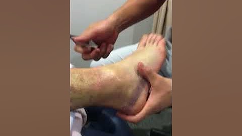 Graston Technique on a grade 2 ankle sprain