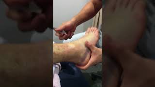Graston Technique on a grade 2 ankle sprain screenshot 3