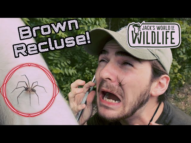 Bite, Brown Recluse Spider