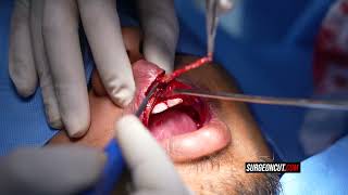 Cosmetic upper lip reduction surgery - Dr. Sunil Richardson
