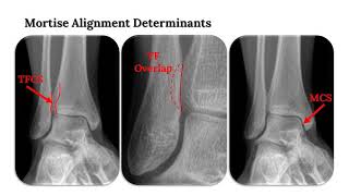 Ankle Fractures: Normal anatomy, normal radiographs