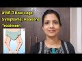 बच्चों के पैरों में Gap(Bow Legs in babies) Symptoms, Reasons and Treatment