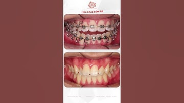 Trước/Sau Niềng Răng Khớp Cắn Hở Thay Đổi Ra Sao?#shorts